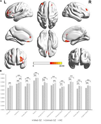 A Real-World Observation of Antipsychotic Effects on Brain Volumes and Intrinsic Brain Activity in Schizophrenia